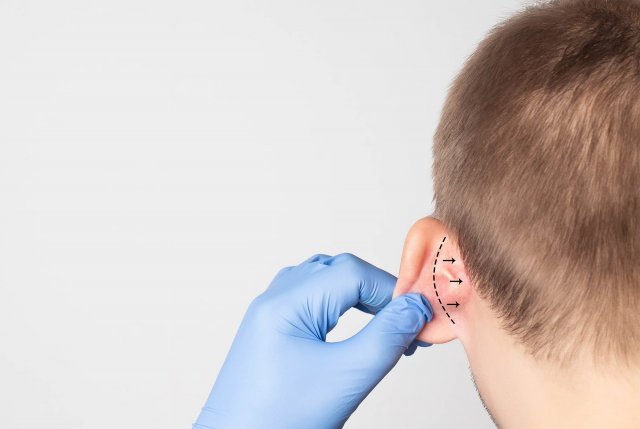Otoplastie