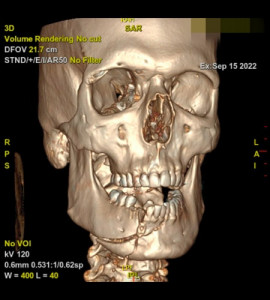 Réduction/osteosynthèse des deux foyers de fracture au Luxembourg