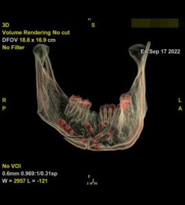 Fracture comminutive paras physe mandibulaire droit post traumatique au Luxembourg