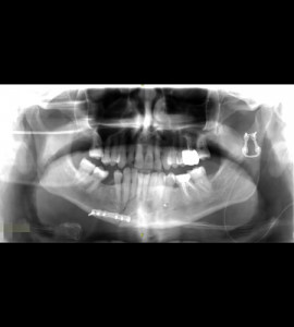 Fracture bifocale de mandibule post traumatique au Luxembourg