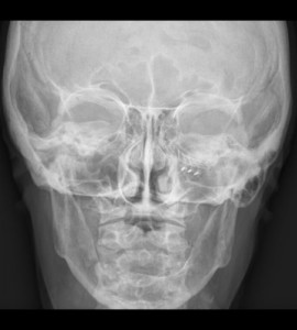 Réduction/osteosynthse par mini plaques titane vissées au Luxembourg
